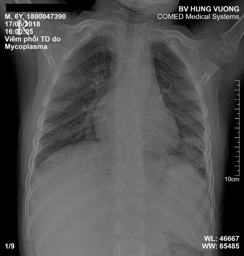 mycoplasma-2