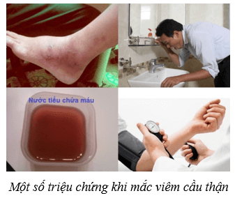 Lý thuyết KHTN 8 Kết nối tri thức Bài 35: Hệ bài tiết ở người